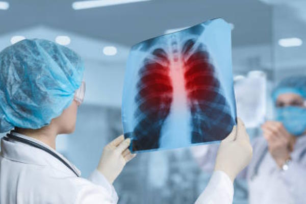 Pravovremeno reagiranje na upalu pluća: ključni korak za prevenciju